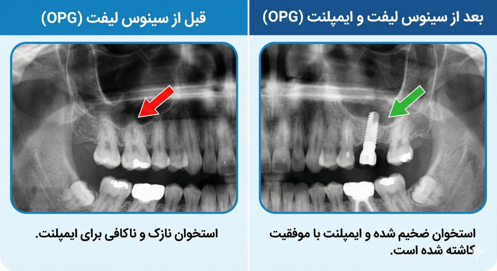 عکس قبل و بعد رادیوگرافی پیوند استخوان