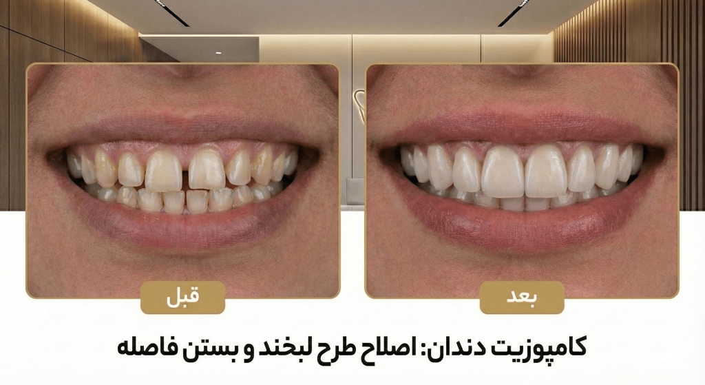 کامپوزیت دندان نمونه کار دکتر صابری