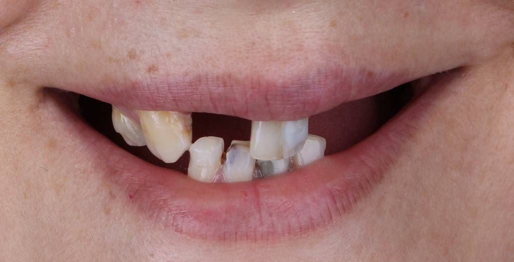 قبل نمونه کار ایمپلنت دکتر صابری 1