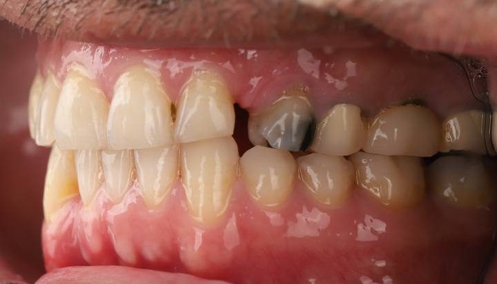 نمونه کار ایمپلنت دکتر صابری 2