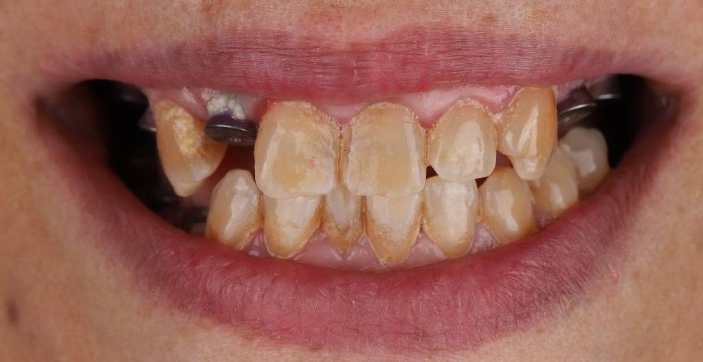 نمونه کار ایمپلنت دکتر صابری- قبل 3