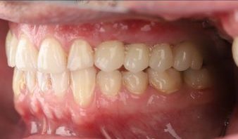 نمونه کار دکتر صابری ایمپلنت بعد