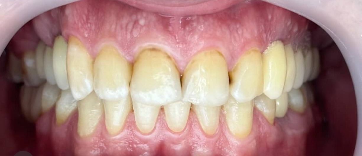 نمونه کار دکتر مهدی صابری ایمپلنت بعد 5