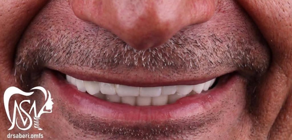 نمونه کار دکتر مهدی صابری ایمپلنت 3 بعد