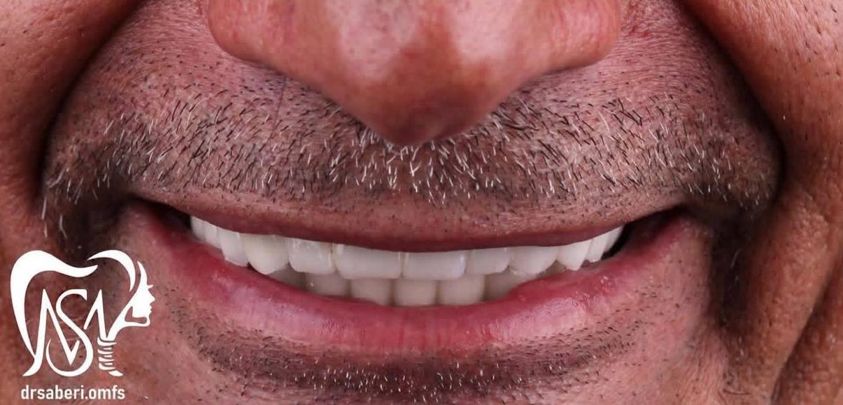 نمونه کار دکتر مهدی صابری ایمپلنت 3 بعد