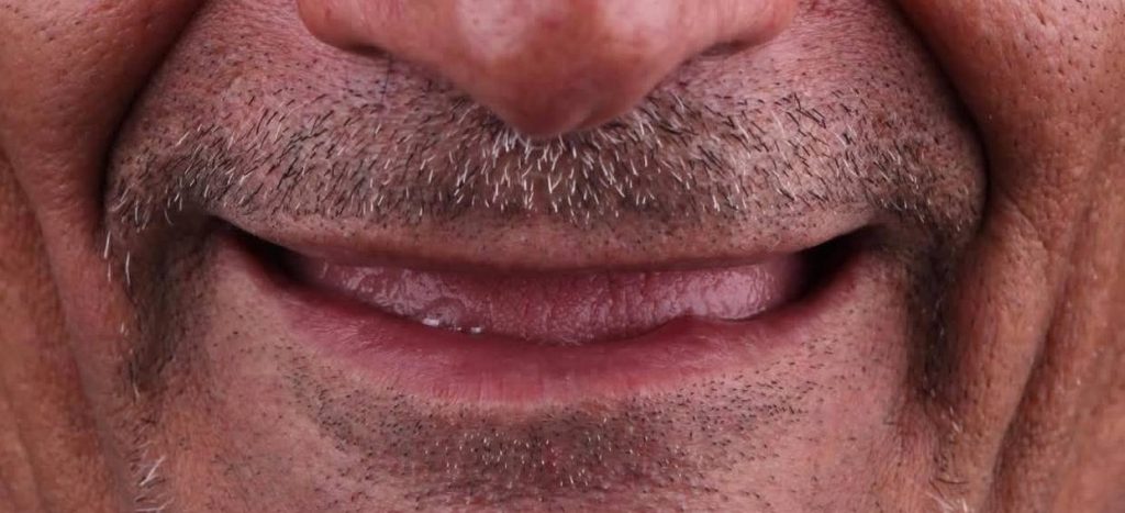 نمونه کار دکتر مهدی صابری ایمپلنت 2 قبل