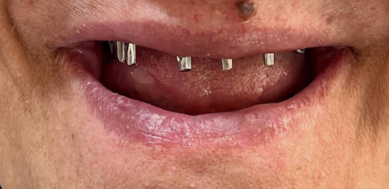 نمونه کار دکتر مهدی صابری ایمپلنت 4قبل