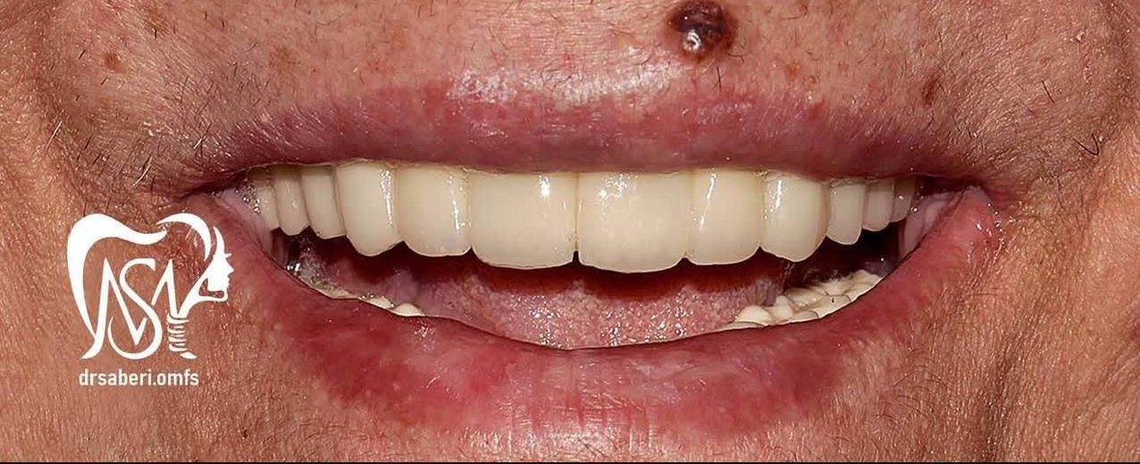 نمونه کار دکتر مهدی صابری ایمپلنت 4 بعد