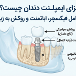 اجزای ایمپلنت دندان چیست؟ جلوگیری از شل شدن قطعات | دکتر صابری