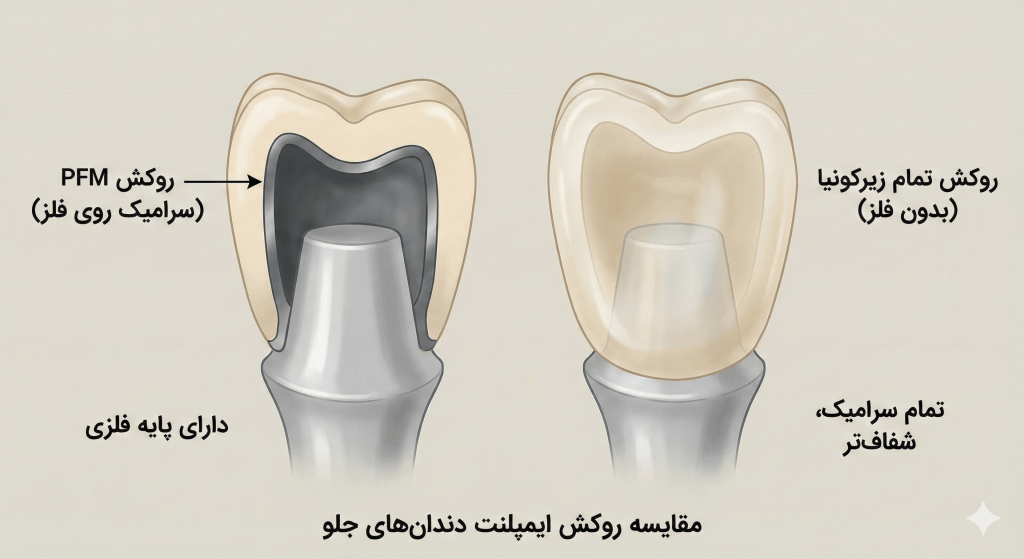 مقایسه روکش ایمپلنت تمام زیرکونیا و PFM برای دندان های جلو