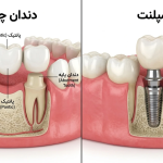 دندان چسبی بهتر است یا ایمپلنت؟ مقایسه هزینه، دوام و راحتی | دکتر مهدی صابری