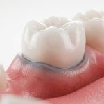 علت آبی شدن لثه کنار ایمپلنت چیست؟ | دلایل، خطرات و درمان