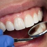 چند دندان را می‌توان همزمان لمینت کرد؟